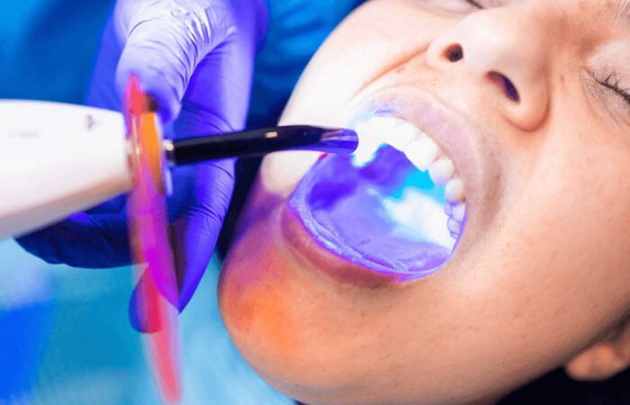 Dental Fillings & Restorations